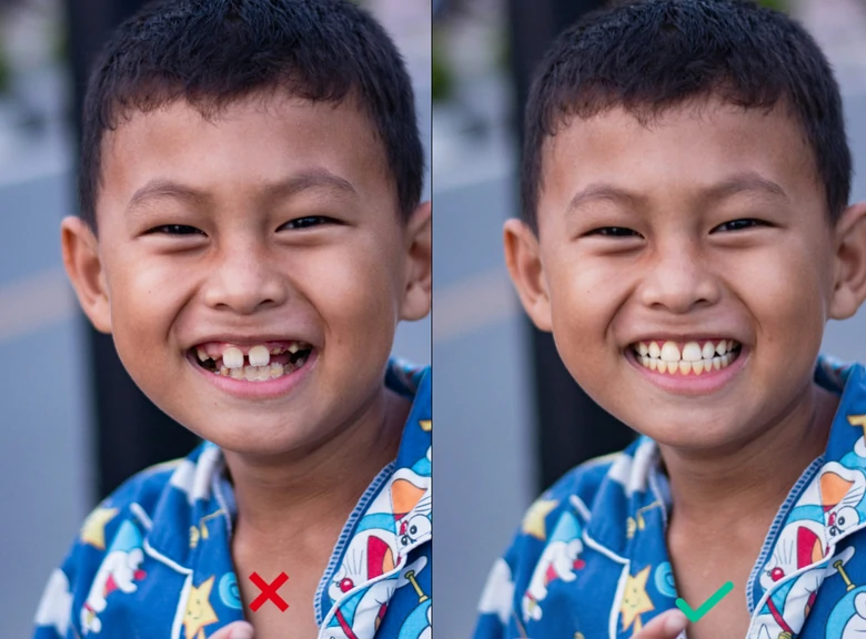 Missing Teeth Before and After Comparison
